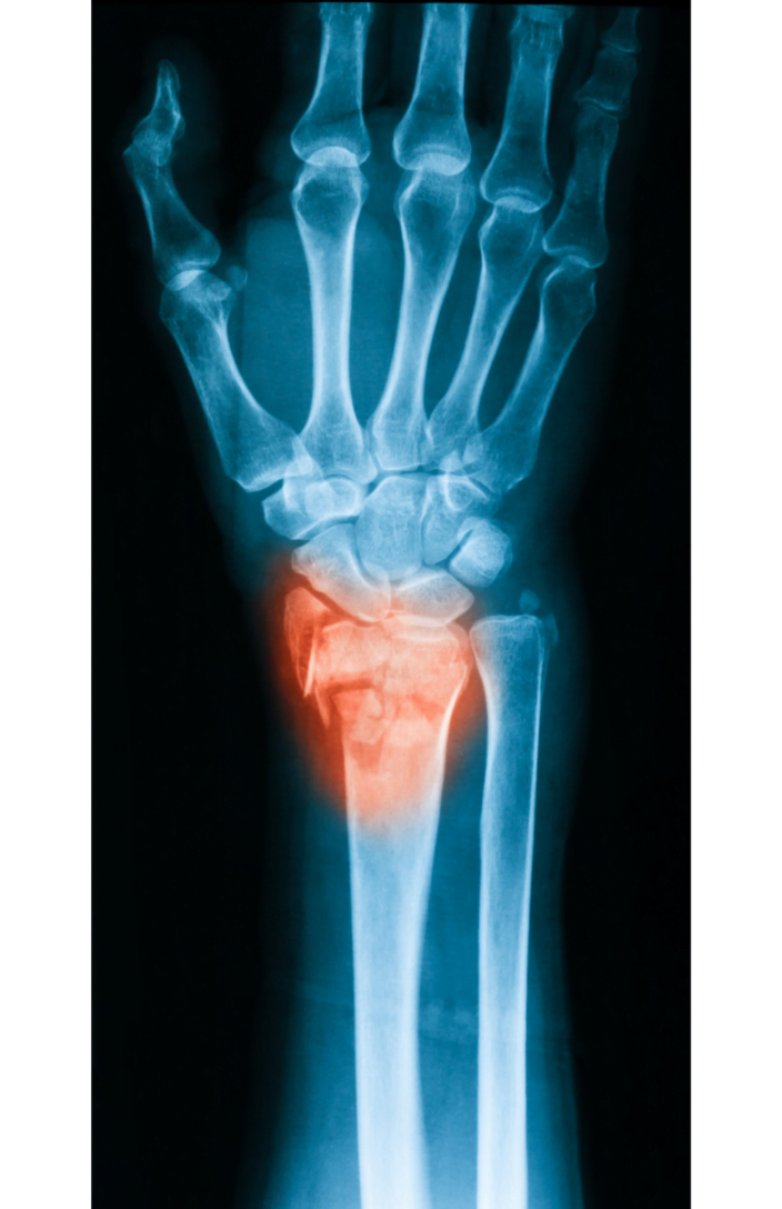 distal radius fracture care x-ray