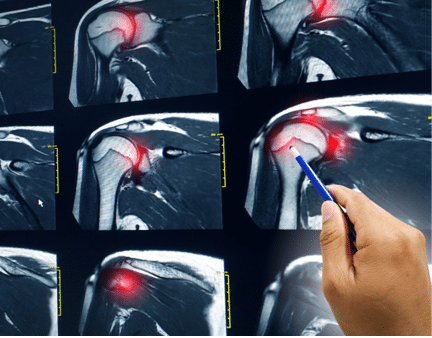 rotator cuff tear can be diagnosed with an MRI scan.