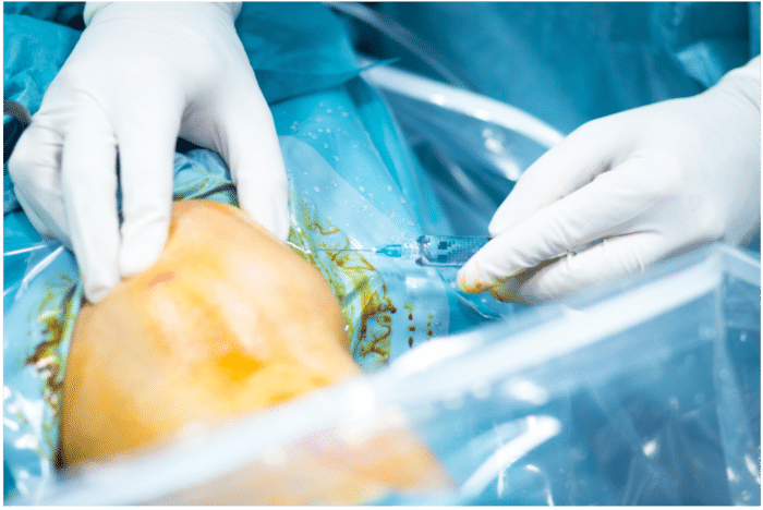 Arthroscopic knee surgery for ACL tear