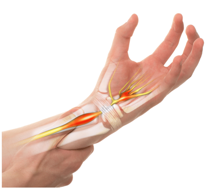 Carpal tunnel syndrome nerve pain