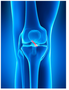 Anterior cruciate ligament ACL tear