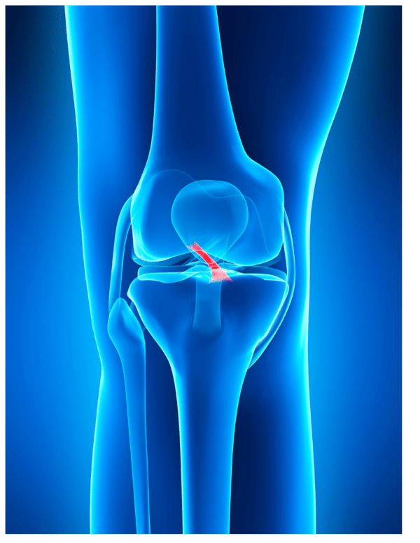 Anterior cruciate ligament ACL tear