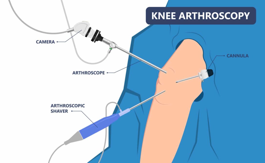Diagram to explain knee arthroscopy surgery