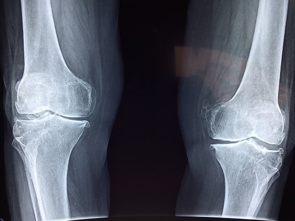 knee x-ray arthritis