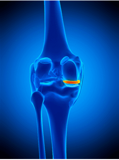 This is your medial meniscus.