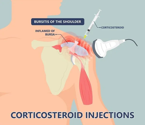 Cortisone Injection in San Jose