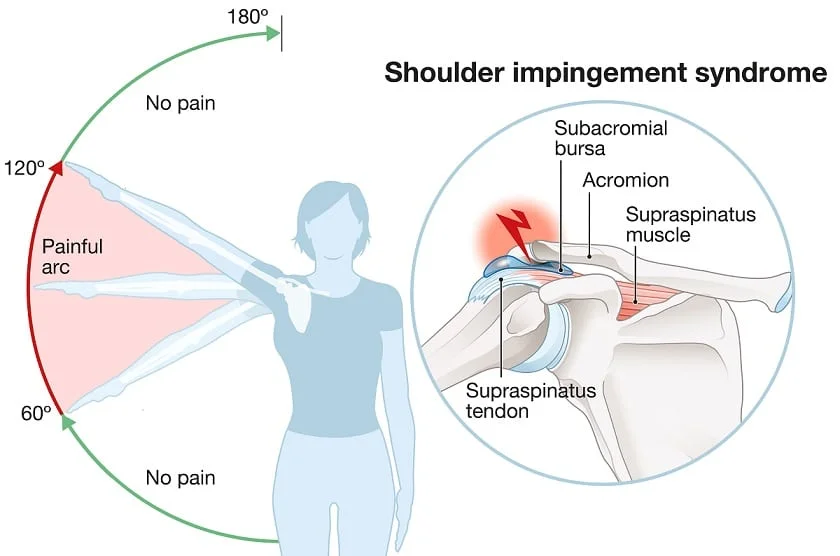 Shoulder impingement pain explained