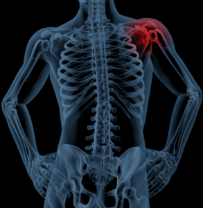 Shoulder impingement joint and shoulder pain symptoms