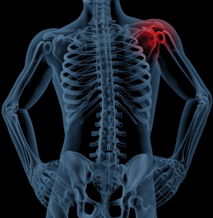 Shoulder impingement joint and shoulder pain symptoms