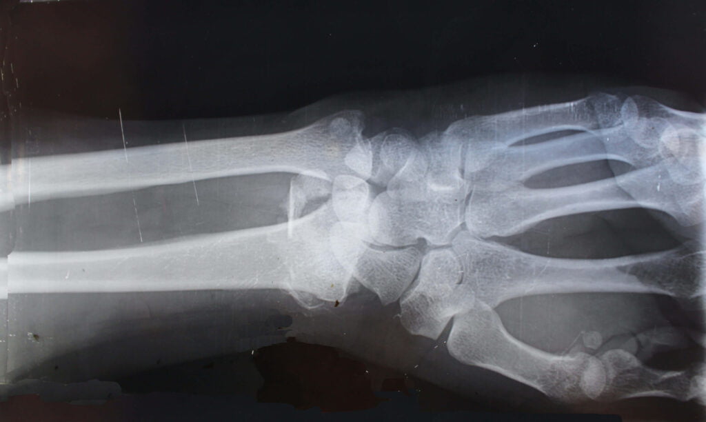 wrist xray view