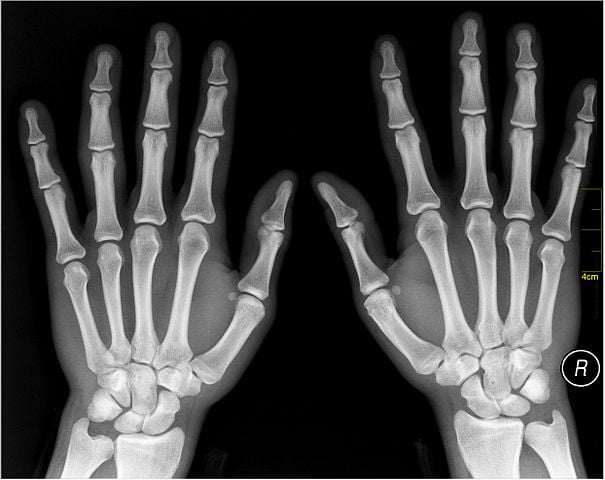 anatomy of the hand bones shown in an xray