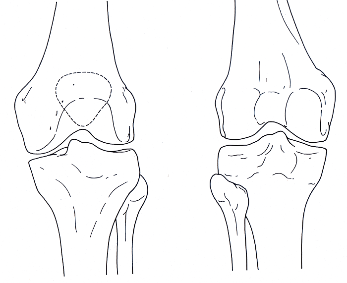 Knee bones include the femur, the patella, the tibia, and the fibula