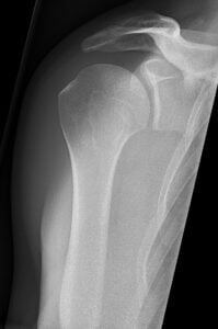 xray showing shoulder anatomy