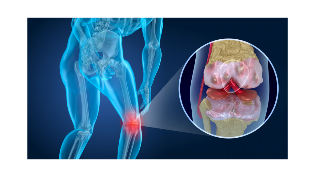 stem cell treatment for knee arthritis san jose