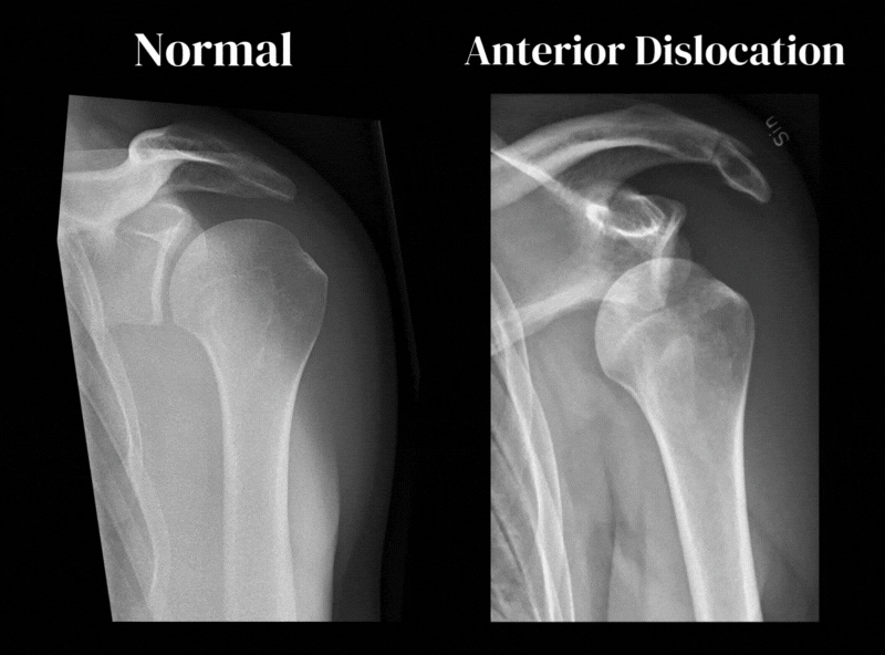 Anterior shoulder dislocation x-ray