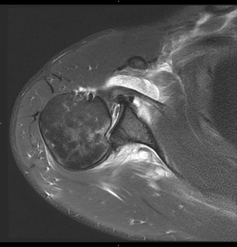 posterior shoulder dislocation MRI scan