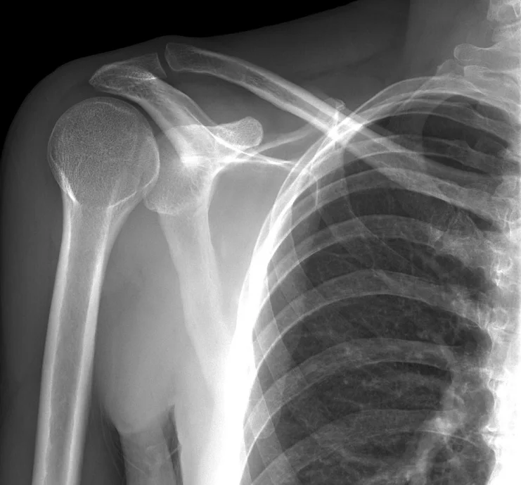 x ray of a posterior shoulder dislocation - anteroposterior AP view