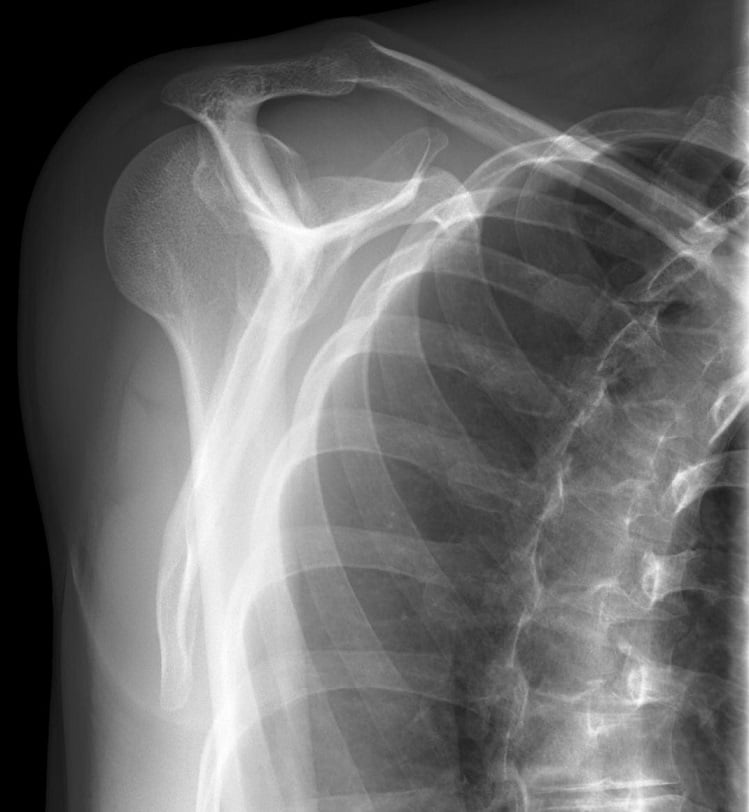 x ray of a posterior shoulder dislocation - lateral view