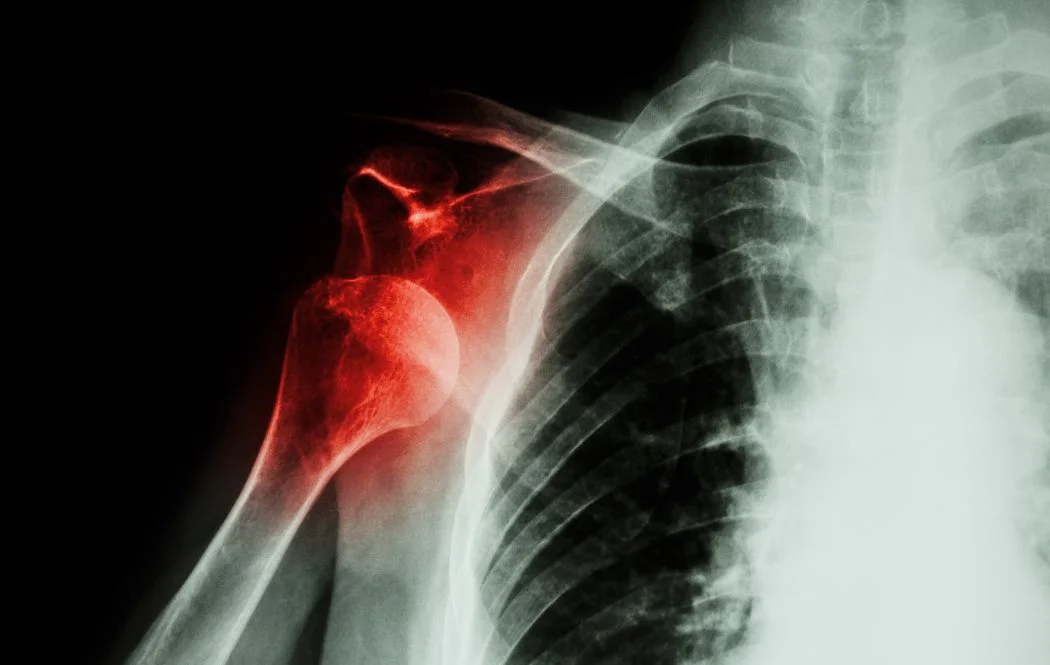 shoulder dislocation xray