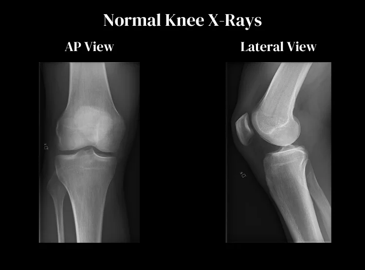 Knee X-ray for ACL Tear