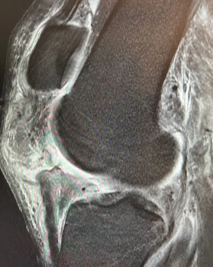 Complete Patellar Tendon Tear MRI