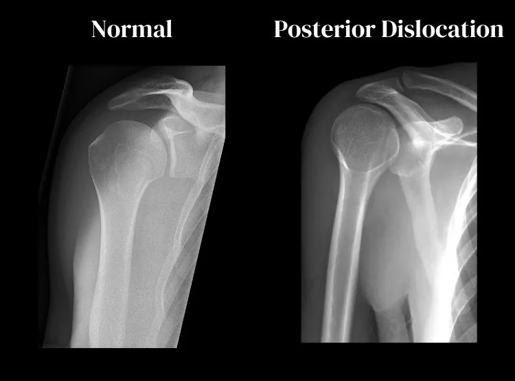Posterior Dislocation X-ray Comparison
