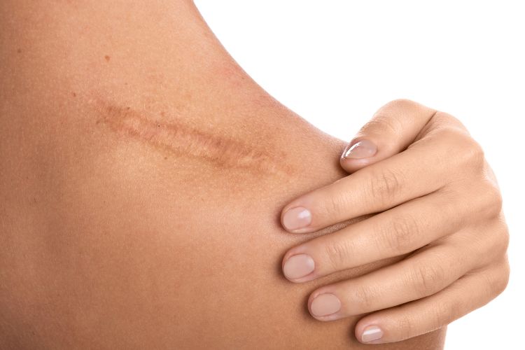 shoulder bursitis scar