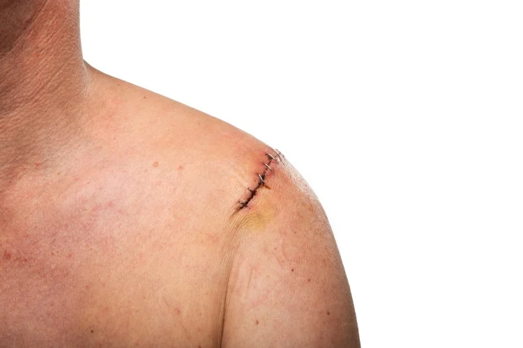 shoulder bursitis wound