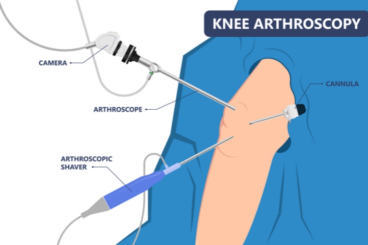 knee arthroscopy surgery