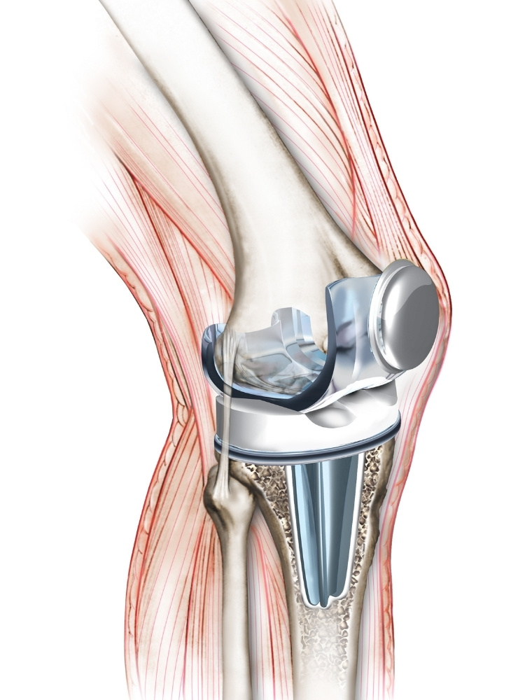 knee replacement illustration
