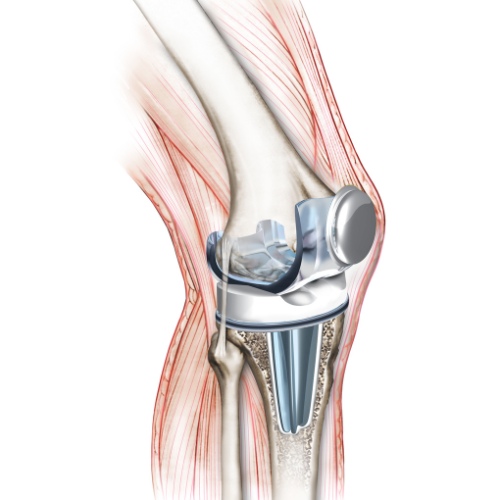 knee replacement illustration