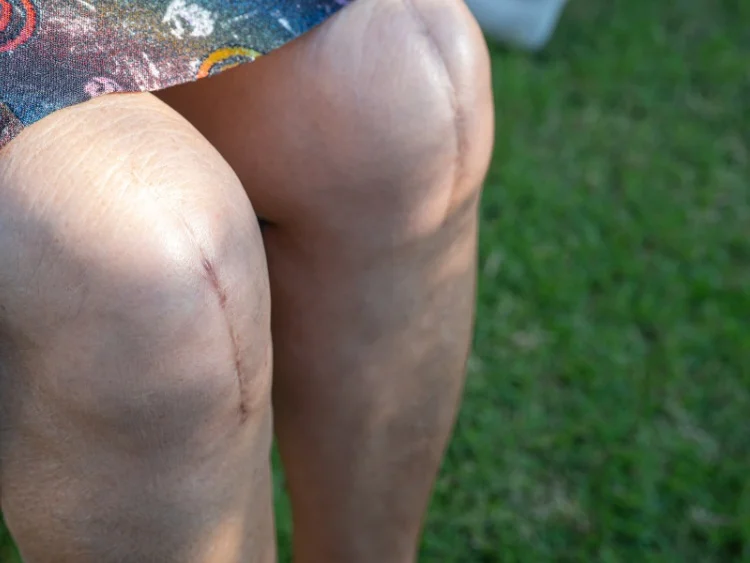 patient with bilateral knee replacement