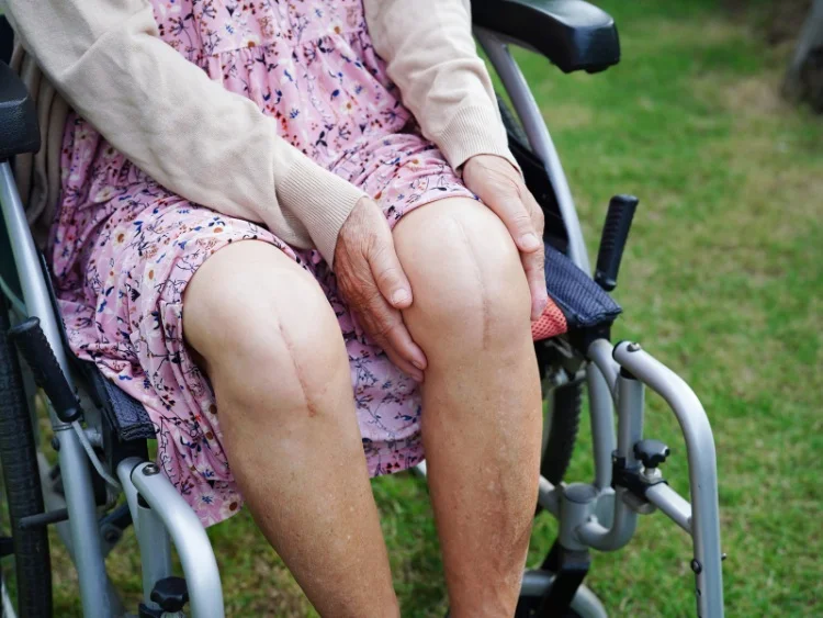 Lady in wheelchair with knee replacement