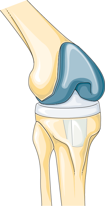 Total Knee Replacement Graphic
