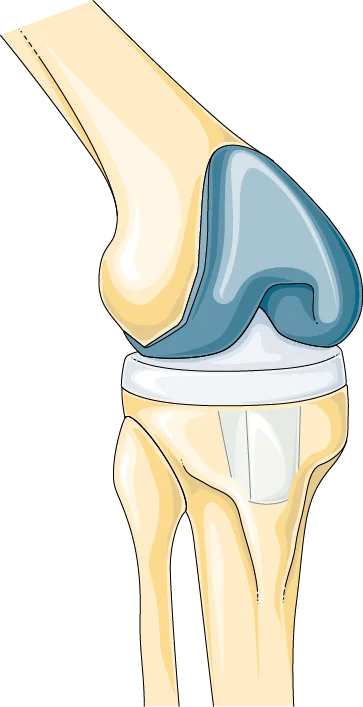 Total Knee Replacement Graphic