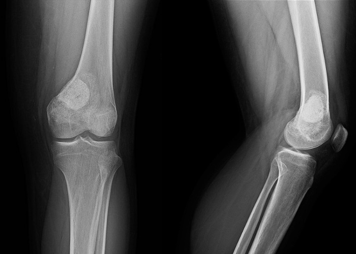 AP and lateral of bone graft surgery