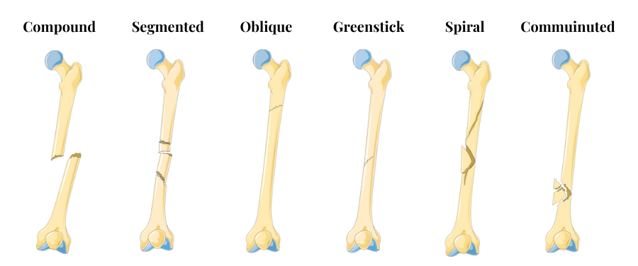 Different types of fracture animated image