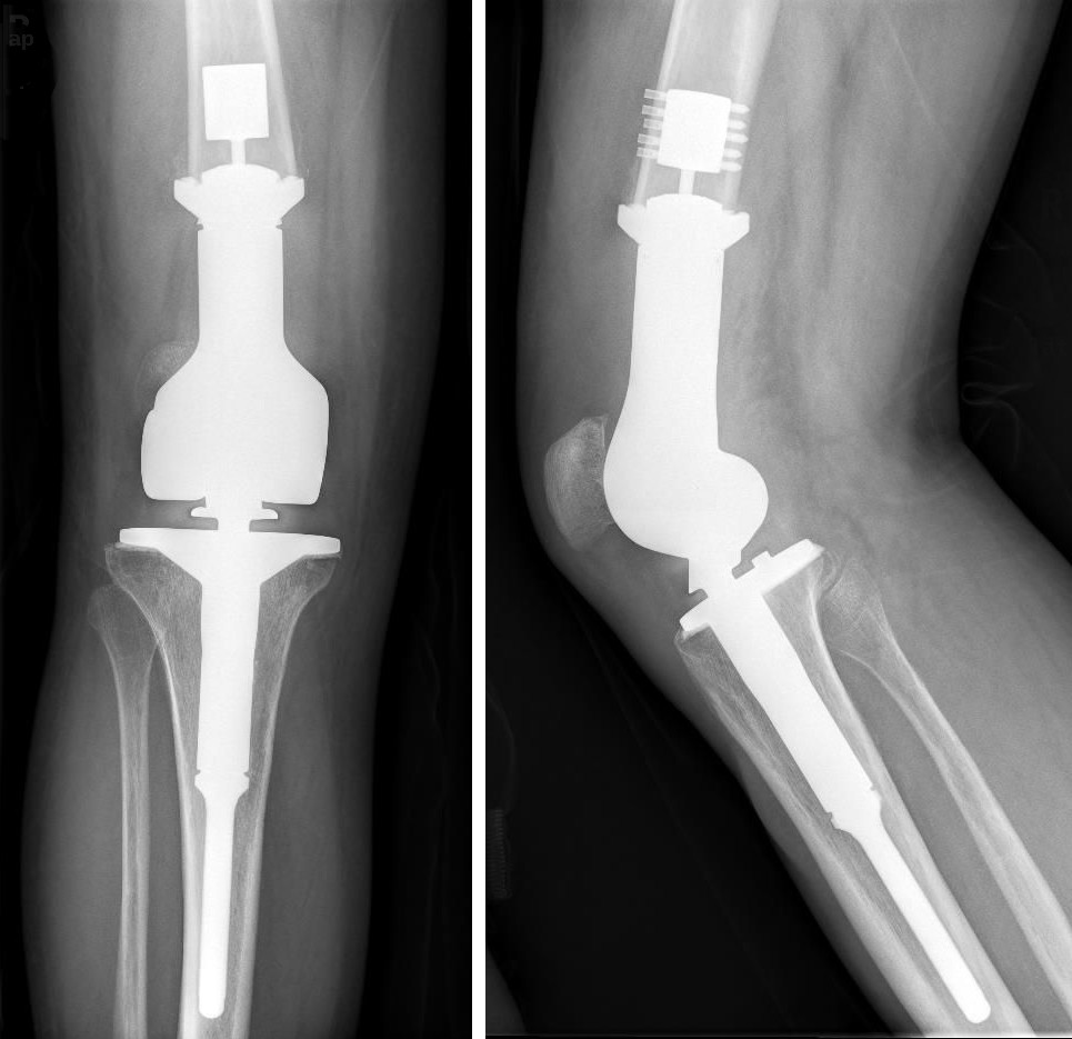 Knee Arthroplasty