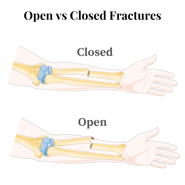 Open vs closed fractures