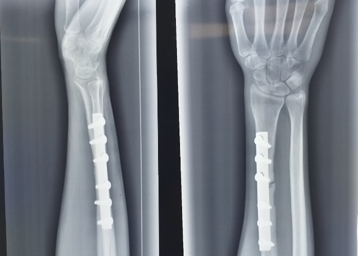 internal fixation of the wrist xray with plate and screws