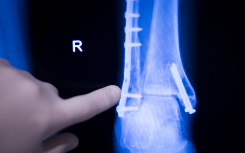 x-ray of ankle fracture with plate and screws