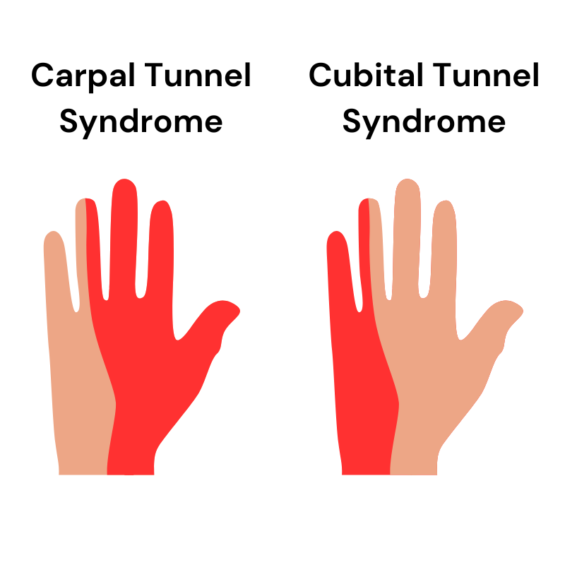 Carpal tunnel vs cubital tunnel difference