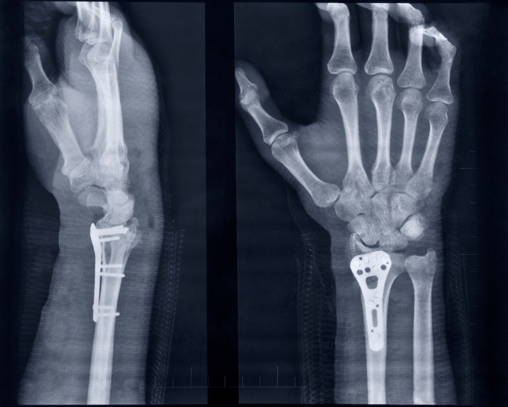 hand x-ray showing wrist plates after fracture