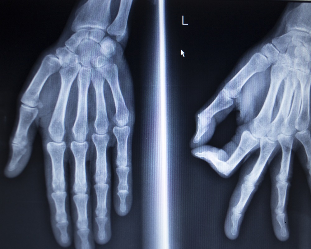 two views of a hand xray