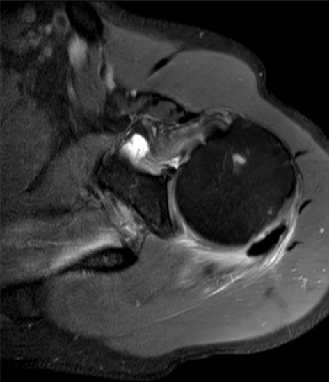 Calcified deposts on the shoulder - MRI scan