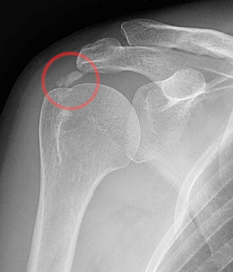 Xray of Calcified deposts on the shoulder - Gartner and Heyer Type I