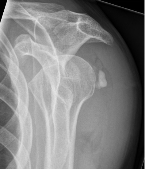 Xray of Calcified deposts on the shoulder - Gartner and Heyer type II