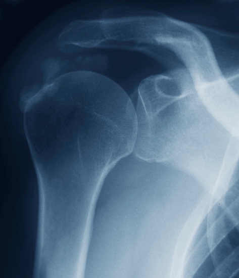 Xray of Calcified deposts on the shoulder Gartner and Heyer Type 3 calcifications