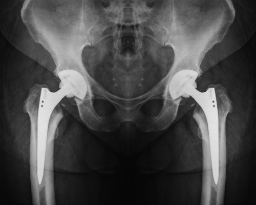 X-ray image of hip