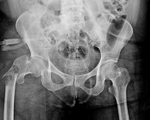 X-ray image of hip